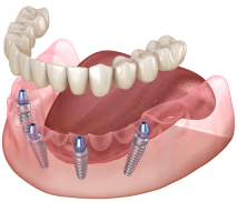 Имплантация All-on-4